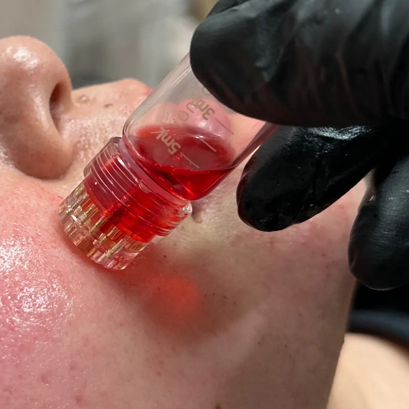 Microneedling Services